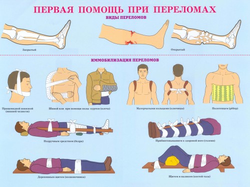 Первая помощь при переломах